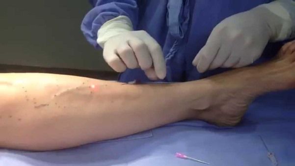 A gravidade das varizes fundamentalmente está relacionada à quantidade e tamanho das veias, que podem levar a formação de feridas nas pernas, as chamadas úlceras varicosas